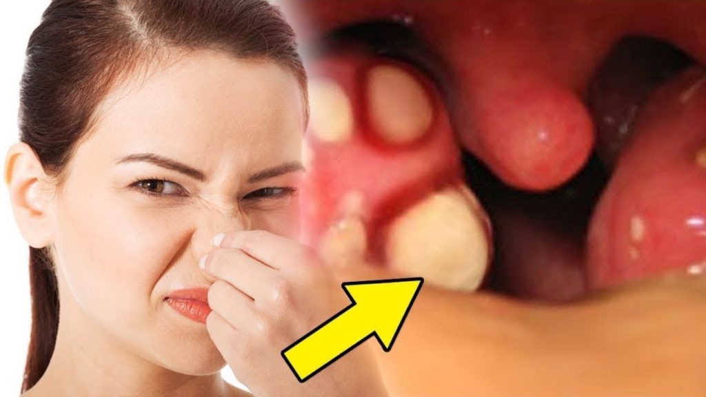 Cómo quitar el mal aliento de la boca - Remedios caseros para el mal aliento